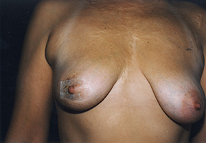 Breast Reconstruction 3a